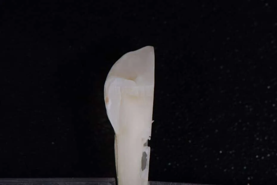 Caries dental mínima intervención