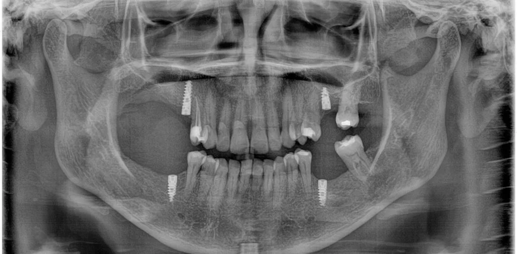 Rehabilitación oral